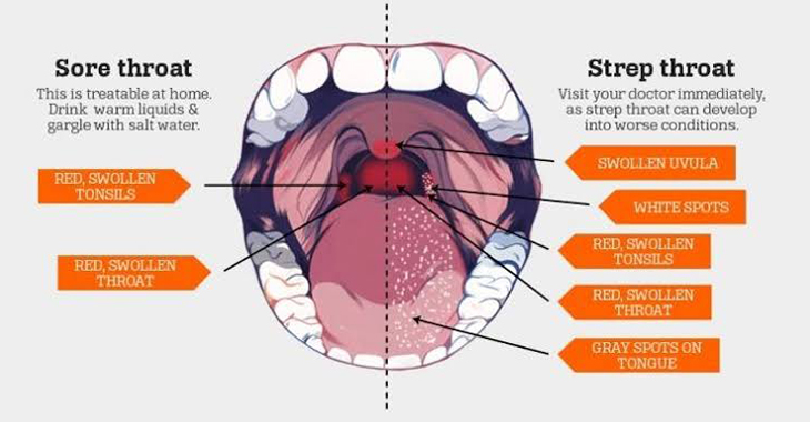 Differences Between Strep Throat And Tonsillitis Vikram Ent Hospital
